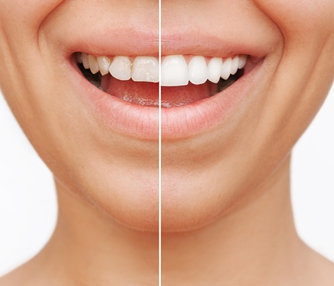 a before-after photo of a patient with veneers