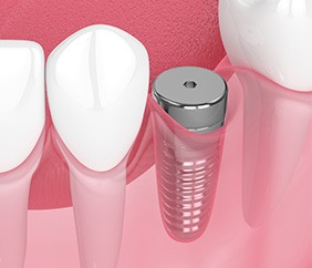 Digital illustration of a dental implant